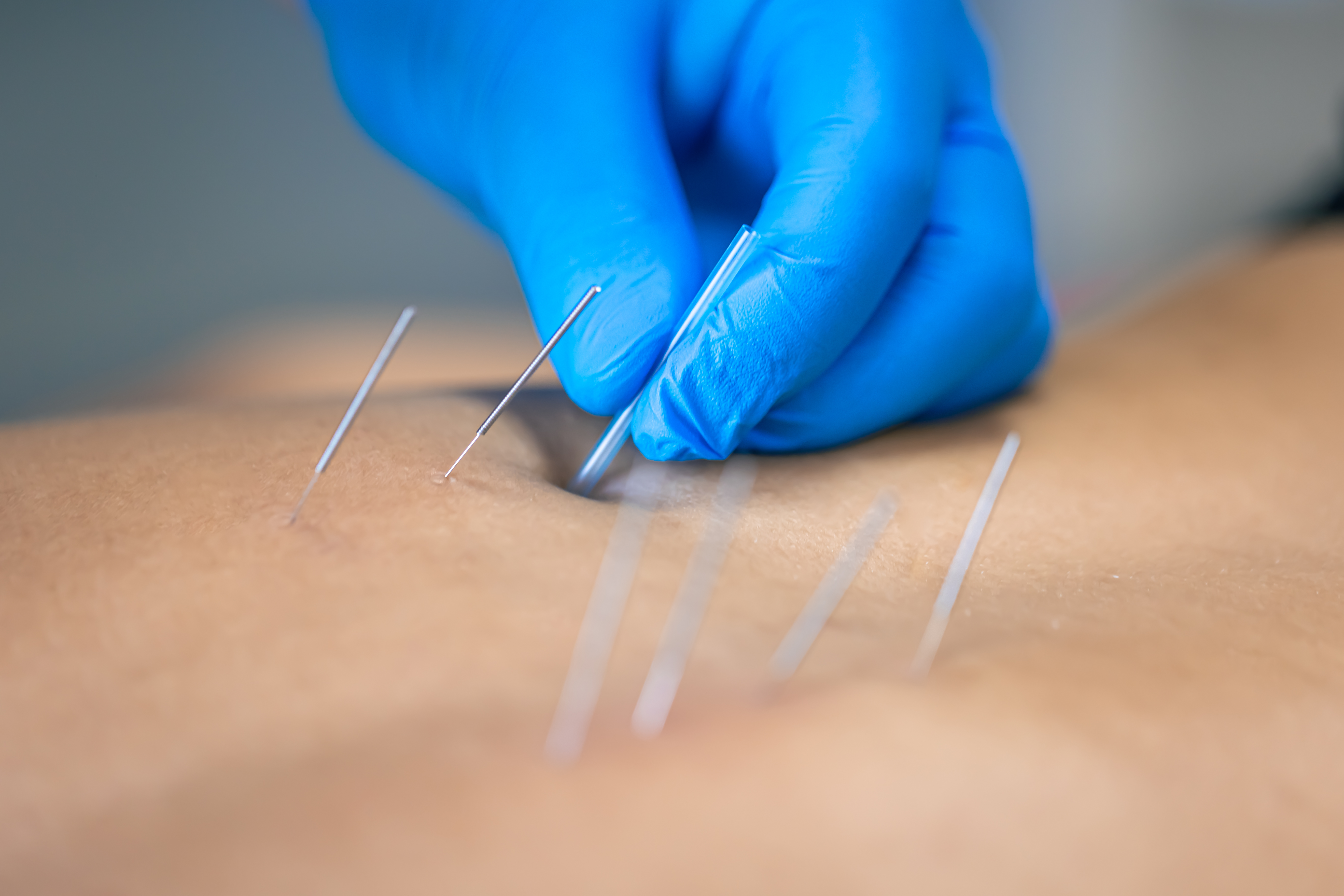 Acupuncture in Nepal: Blending Tradition with Modern Care